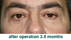 plastic-surgery-blepharoplasty